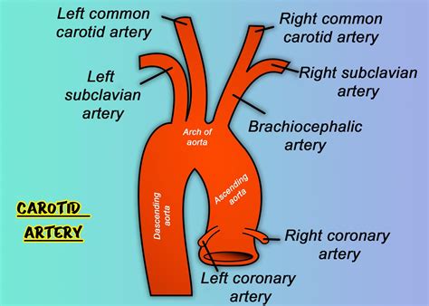 Carotid Dissection Cardiovascular Medbullets Step 23 Vrogue Co