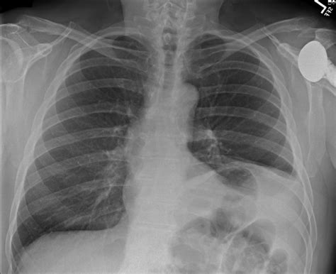 Anteroposterior Chest Radiograph Shows An Elevated Left Hemidiaphragm
