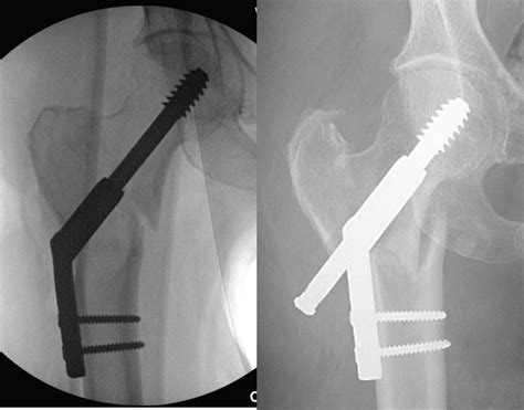 Figure Intra Op And Post Op Images Of It Femur Fracture Treated With