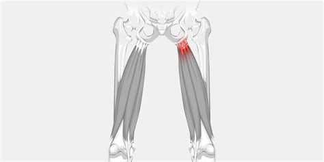 High Hamstring Tendinopathy A Persistent Pain In The Butt