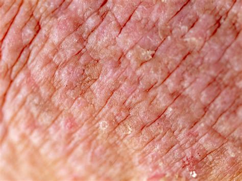 Skin Rashes Dermatitis Eczema Images And Photos Finder My Xxx Hot Girl