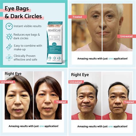 How To Get Rid Of And Remove Eye Bags Instantly Ageless