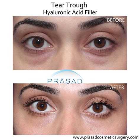 Under Eye Filler For Hollow Eyes Tear Troughs And Eye Bags