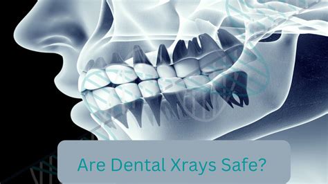 Are Dental X Rays Safe