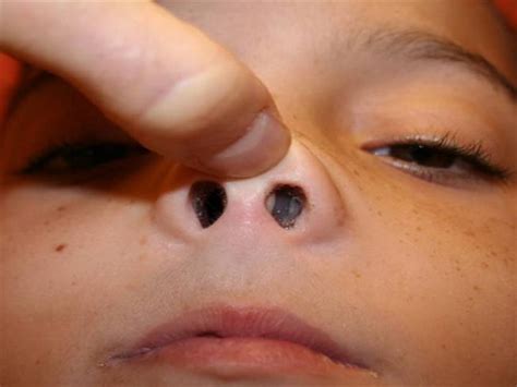 Nasal Polyps In Children Authorstream
