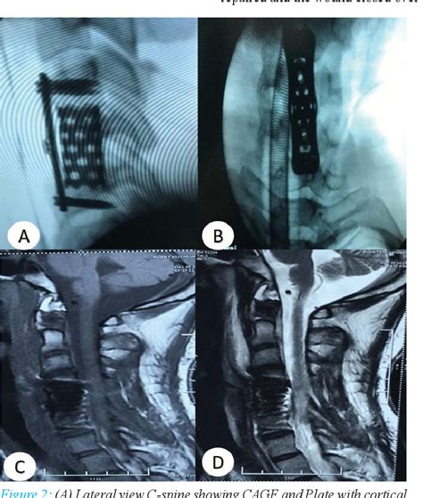 Figure 2 From Anterior Cervical Corpectomy And Fusion With Excision Of