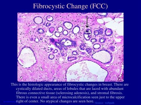 Pin On Breast Fibrocystic Disease