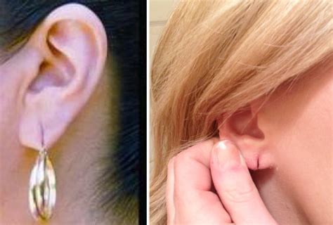 Torn Ear Lobe Repair Los Angeles