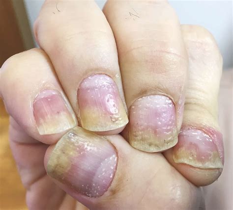 Psoriasis Nails Oil Spot