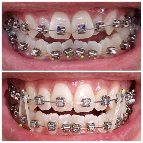 Six Month Damon Braces Progress Hooks And Rubber Bands Added Today