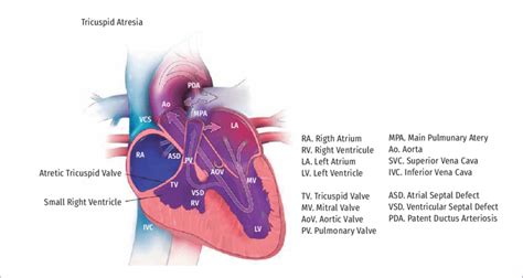 Hypoplastic Right Heart Syndrome Q226 Download Scientific Diagram