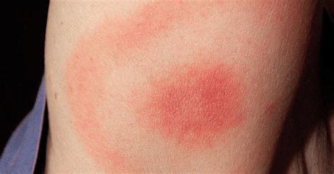 Experts Warn Of Increases In Tick Borne Powassan Virus Cbs Philadelphia
