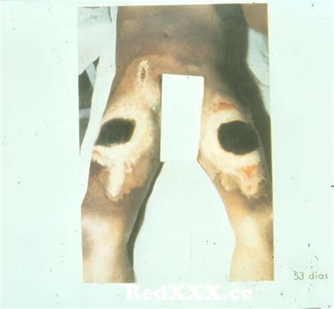 Radiation Burns On A Firefighter Who Was Working On The Chernobyl