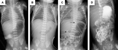 X Ray Series Of Patient 1 A Prior To Surgery With Distended Stomach