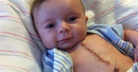 Open Heart Surgery Scar Baby Goimages Radio