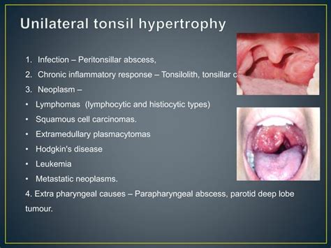 Palatine Tonsil Its Anatomy Diseases And Their Management