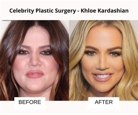 Khloé Kardashian Before - Khloé Kardashian, Before and After 