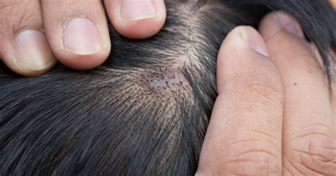 How To Get Rid Of Eczema On The Scalp Livestrongcom
