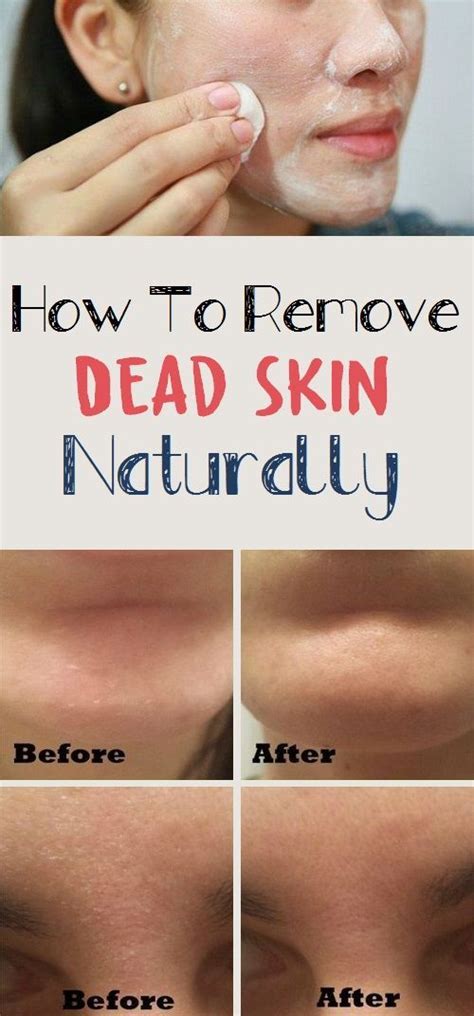 Jan 02, 2020 · a natural sponge can work well to get rid of dead skin cells on the face. How To Remove Dead Skin Naturally? | Dry skin care, Dead ...
