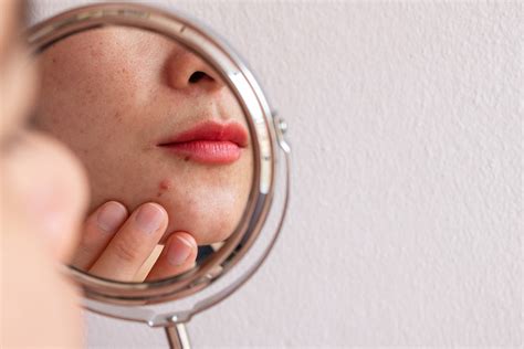 5 Habits You Dont Realise Are Making Your Acne Worse