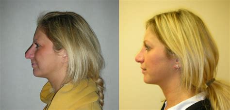 Rhinoplasty Nose Job Surgery In Manchester And London Waseem Saeed