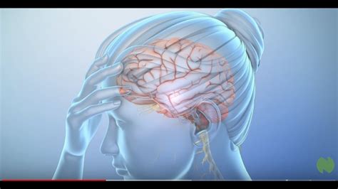What Is A Migraine Headache Youtube