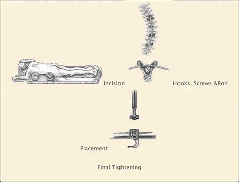 Posterior Approach Houston Tx Modern Spine