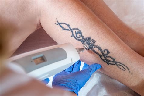 Tatueringsborttagning Caroli Skönhetslounge Q Switchad Yag Laser