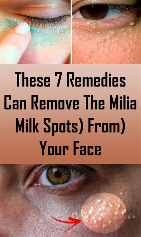 These 7 Remedies Can Remove The Milia Milk Spots From Your Face