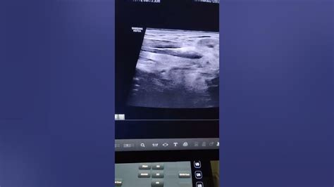 Usg Submandibular Sialolithiasis Ultrasound Youtube