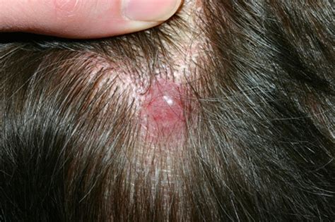 Skin Cancer Types Basal Cell Carcinoma Bcc Squamous C