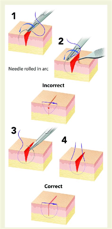 When Possible Wound Edges Should Be Everted To Reduce Scar Formation