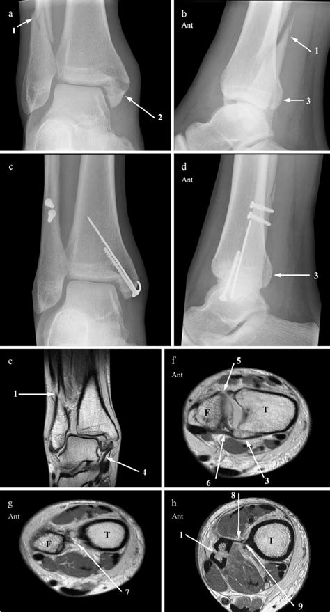 Ap A And Lateral B Radiographs Show An Oblique Fibula Fracture