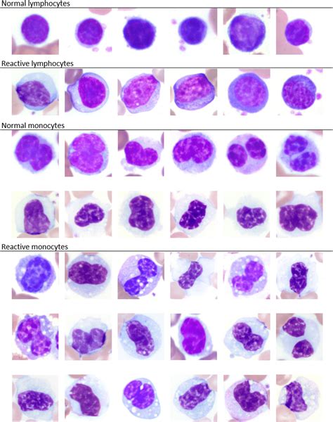 Image Composite Of Normal And Reactive Lymphocytes And Monocytes