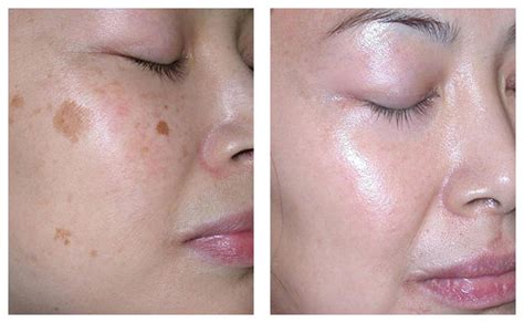 Laser Skin Pigmentation Removal And Treatment In Melbourne Dermacare