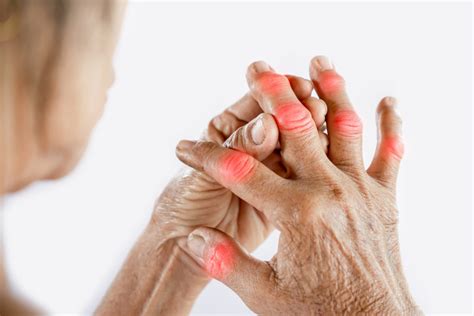 Get Physio For Finger Arthritis Toronto Vaughan Simply Align Rehab