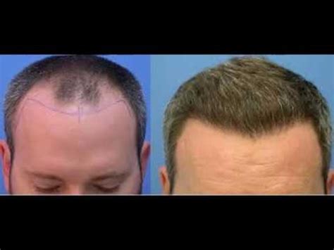 Whenever guys think about using minoxidil for beard growth, they wonder if the beard is permanent. Minoxidil Before And After Beard Result / Minoxidil Beard Before And After Results - Beard ...