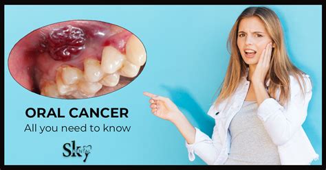 Oral Cancer All You Need To Know Sky Dental Care Hospital