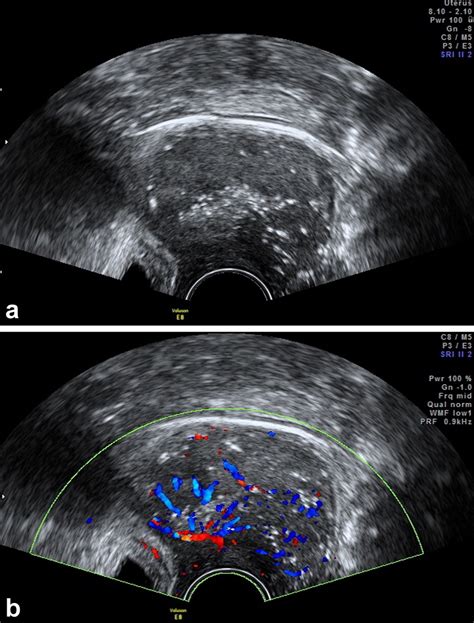 Three Dimensional Transvaginal Tomographic Ultrasound Imaging For