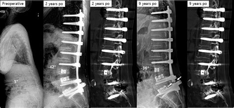 Metal Failure And Nonunion At L5 S1 After Long Instrumented Fusion