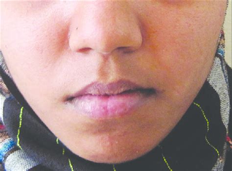 Year Old Female Patient With Swelling On The Right Side Of The Face And