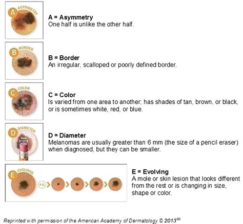 Early Detection Of Melanoma Reviewing The ABCDEs Journal Of The American Academy Of Dermatology