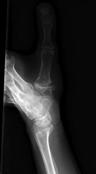 Arthrose In Den Finger Hand Arthrose Gicht Bilder Behandlungtherapie