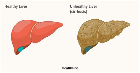 Liver Disease Types Of Liver Problems Causes And More