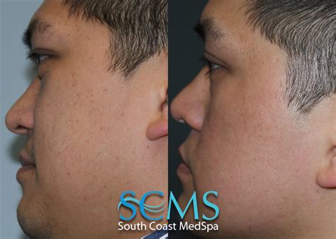 Laser Skin Resurfacing Before And After La San Diego