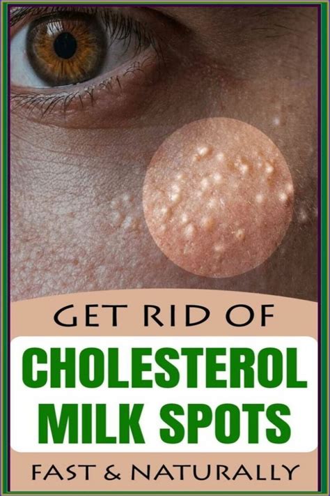 7 Remedies To Get Rid Of Cholesterol Milk Spots Naturally Perfecttips