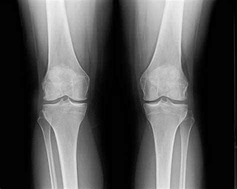 Front Knee Joint X Ray Of Mature Female With Osteoarthritis Photograph
