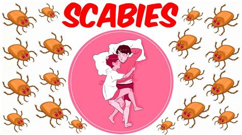 Scabies Youtube
