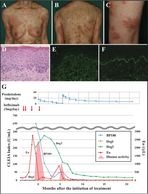 Figure 1 From Infliximab Induced Bullous Pemphigoid And Anti Desmoglein