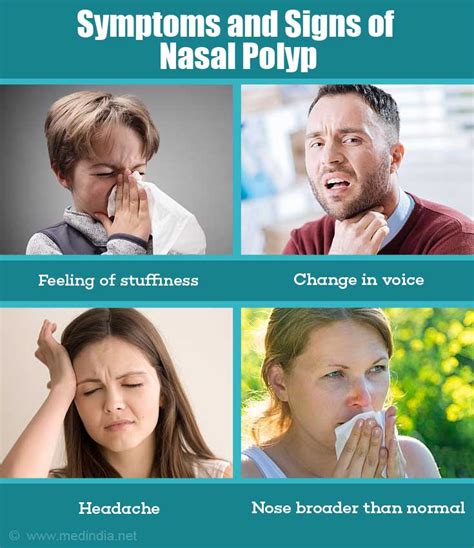 Nasal Polyp Causes Symptoms Diagnosis Treatment Health Tips